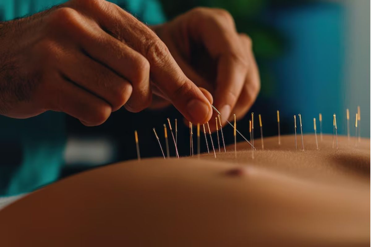 Origem e história da acupuntura